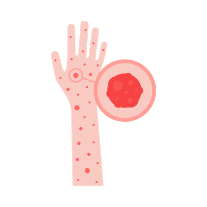 Urticaria