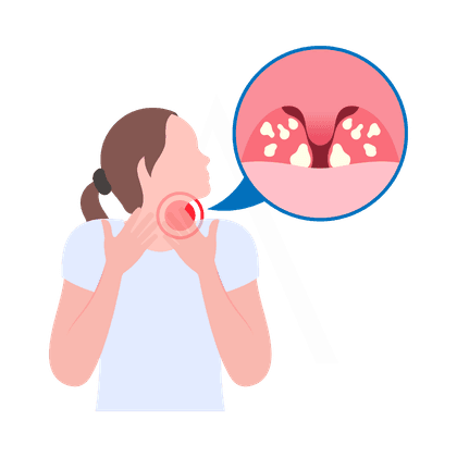 Angina y amigdalitis